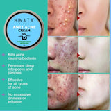 Hinata - Anti Acne Cream 29g