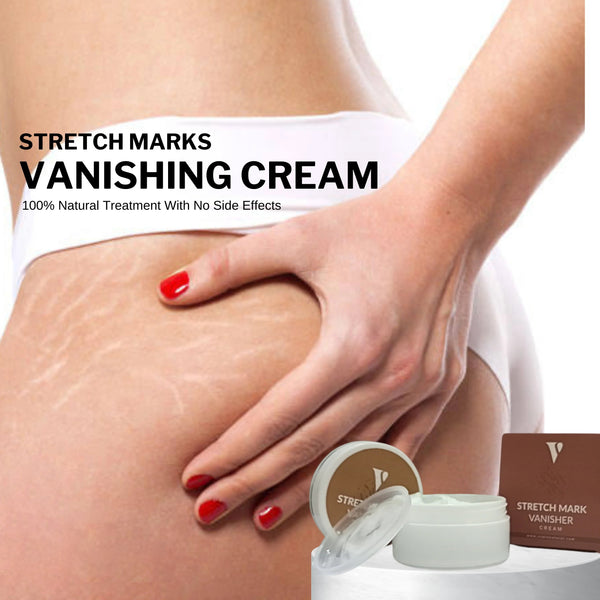 Vcare - Stretch Mark Vanishing Cream